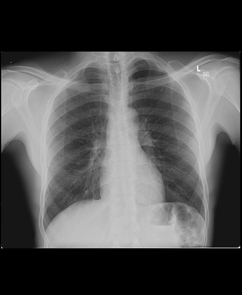 NORMAL CHEST ANATOMY ΦΥΣΙΟΛΟΓΙΚΗ ΑΝΑΤΟΜΙΑ ΠΝΕΥΜΟΝΟΣ 1 st πλευρα Ωμοπλατη Tραχεια Τροπιδα Aορτικο τοξο Δ