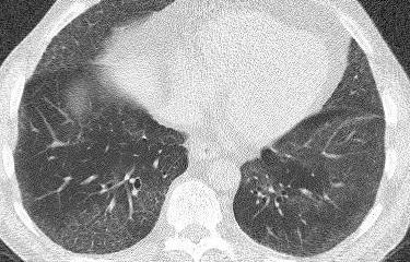 3. LOW DOSE Screening F/U