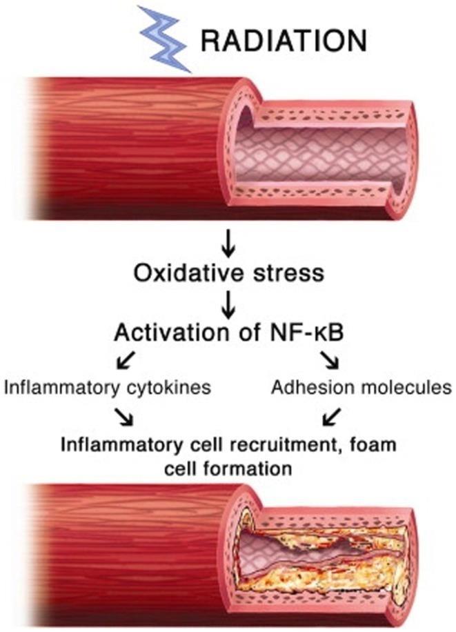 ΑΚΤΙΝΙΚΗ ΣΤΕΦΑΝΙΑΙΑ ΝΟΣΟΣ Wound healing and fibrosis in tissue Proposed