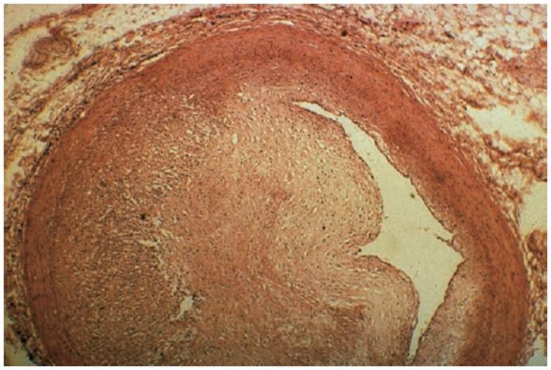 ΑΚΤΙΝΙΚΗ ΣΤΕΦΑΝΙΑΙΑ ΝΟΣΟΣ Significant fibrosis of the
