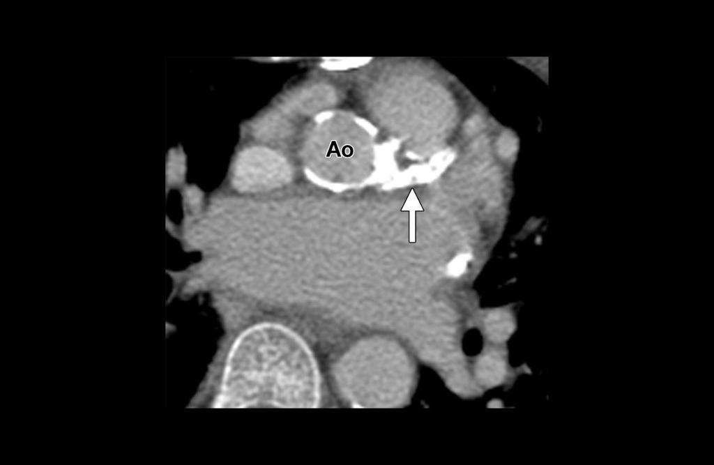 Severe radiation-induced coronary artery disease that developed after whole-chest irradiation for Wilms tumor.