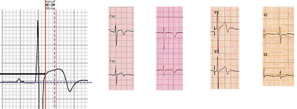 Μalholtra A et al Jacc 2017 A Β C D A: ST ΜΕ ΤΟ ΚΥΡΤΟ ΠΡΟΣ ΤΑ