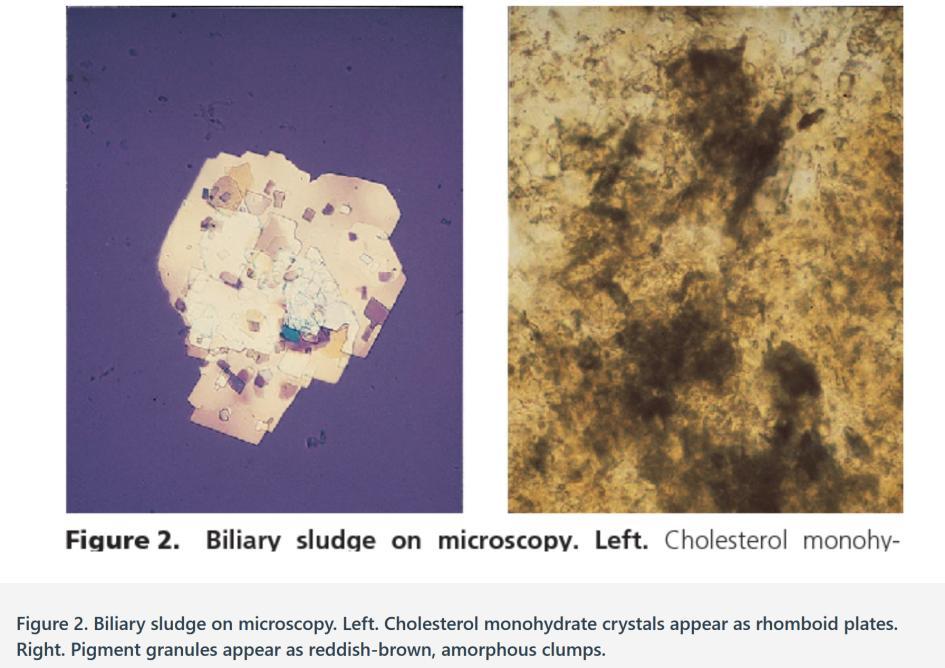 ΔΙΑΓΝΩΣΤΙΚΑ ΕΡΓΑΛΕΙΑ Η μικροσκόπηση της χολής αποτελεί μια ποιοτική ανάλυση. Οι κρύσταλλοι μονοϋδρικής χοληστερόλης εμφανίζονται ως ρομβοειδή πλάκα, συχνά με διάμεση εγκοπή (Εικόνα 2, αριστερά).