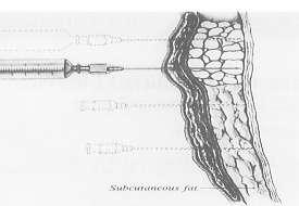 τρόπο ώστε να δημιουργηθεί πομφός. Κατόπιν, με την βελόνη κάθετα στο δέρμα ενίονται επιπλέον 10 ml εν τω βάθει υποδόρια. Εικόνα 9.