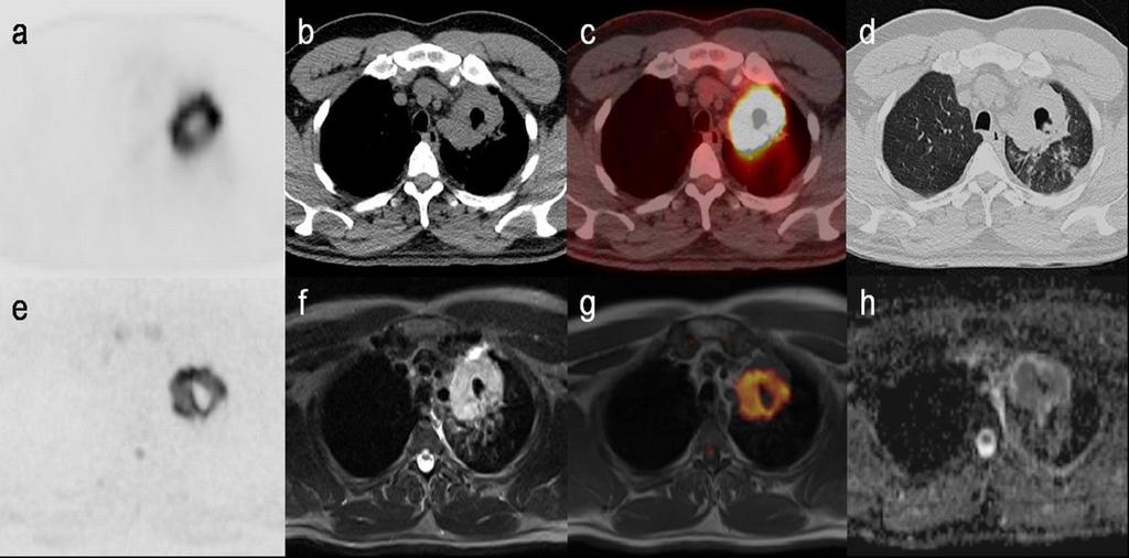 Multimodality imaging Καρκίνωμα εκ μεγάλων κυττάρων T1: διαφοροποίηση φυσιολογικών και λιπωδών ιστών.