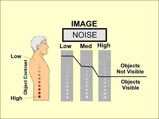 Ποιότητα εικόνας CT : Θόρυβος Ο θόρυβος είναι ανεπιθύμητο απεικονιστικό χαρακτηριστικό που μειώνει τη διακριτικότητα συγκεκριμένων τύπων δομών.