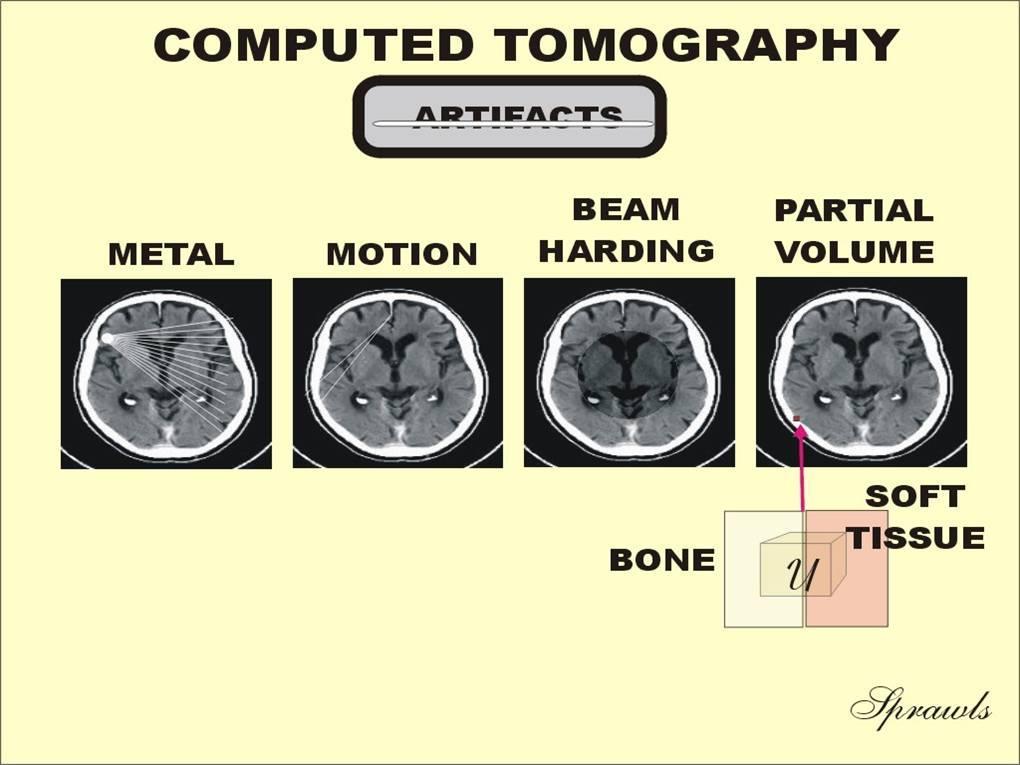 Ποιότητα εικόνας CT : Ψευδοεικόνες - Artifacts Ψευδοεικόνα είναι κάτι που εμφανίζεται σε μία εικόνα-ακτινογραφία το οποίο δεν αποτελεί οπτικοποίηση ενός πραγματικού αντικειμένου ή δομής στο σώμα του