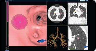 Εικόνα 1: LungPoint VBN System Cone-Beam CT with Augmented Fluoroscopy Combined With Electromagnetic Navigation Bronchoscopy for Biopsy of Pulmonary Nodules H Electromagnetic navigation bronchoscopy