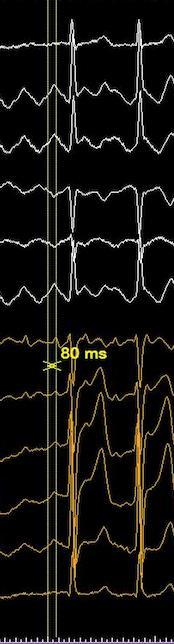 1. CTI flutter 3. Periroof flutter 2.