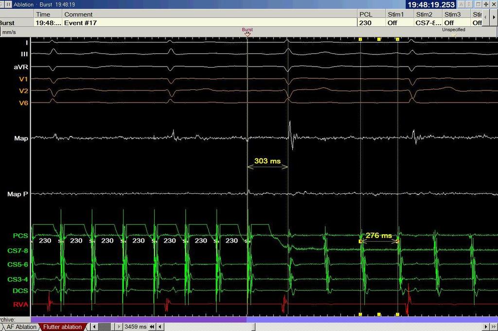 Entrainment from proximal