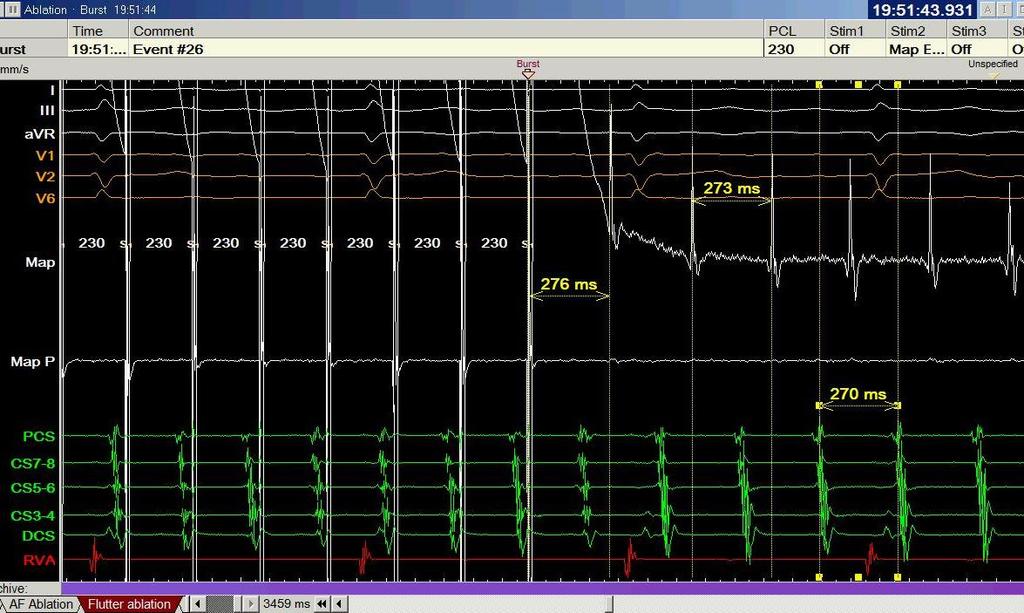 Entrainment from anterior mitral