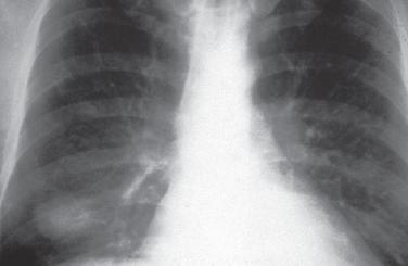 Tuberculosis & άτυπα, PCP, CMV, Nocardia) Συνικθσ διάςπαρτθ/κνσ λοίμωξθ χωρίσ αναπνευςτικι ςυνδρομι (φυςιολογικι CXR) Σε αςκενείσ με