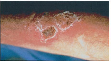 Κλινικές εκδηλώσεις (δέρμα) τυπική βλάβη: βλατίδα με μαλθακό/