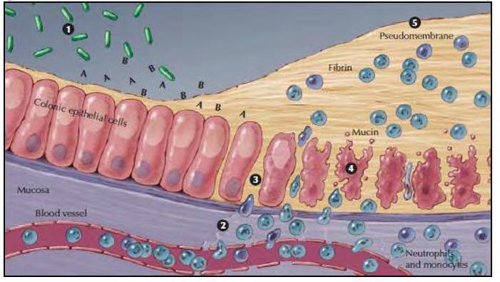 Εικόνα 11. Ο μηχανισμός δράσης των τοξινών Α και Β[Poutanen SM, Simor AE. 2004. Clostridium difficileassociated diarrhea in adults. CMAJ 171: 51-8 ]. 2.6 Το εύρος των ασθενειών που προκαλούνται από λοίμωξη του C.