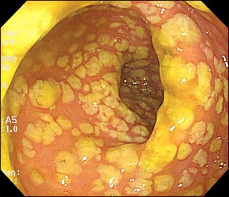 Εικόνα 12. Ψευδομεμβρανώδης κολίτιδα στο παχύ έντερο λόγω λοίμωξης από C.difficile [Korean J Gastroenterol. 2010 Dec;56(6):387-390. Korean]. 2.7 Διάγνωση του C.difficile Το C.