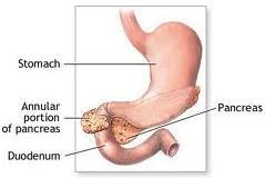 Συγγενείς ανωμαλίες παγκρέατος Αγενεσία-απλασία (στεατόρροια, σακχαρώδης διαβήτης) Έκτοπο πάγκρεας (πχ στο στομάχι, 12/λο, απόφυση Μeckel.