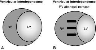 Εικόνα 11: Σχηματική απεικόνιση της αριστεράς κοιλίας(lv) και της δεξιάς κοιλίας(rv) καθώς και της κοιλιακής αλληλεξάρτησης (Ventricular interdependence) σε φυσιολογική (Α) και παθολογική (Β)