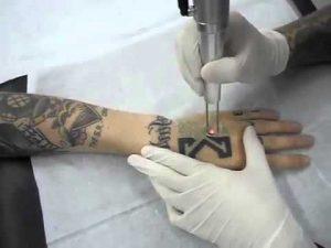 Η διαδικασία αφαίρεσης του τατουάζ είναι αρκετά δαπανηρή, χρονοβόρα και επώδυνη.