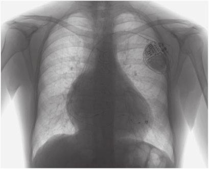 Inmaculada Sanchet (Ramony cajal hospital). showing MRAT in a range from 2 to 7%.