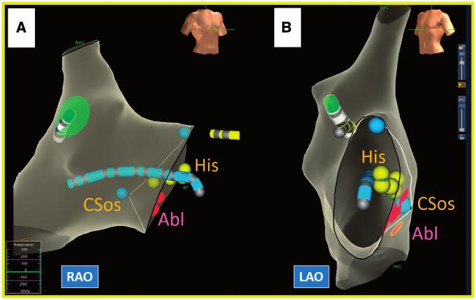 Arrhythmias in congenital heart disease 1720g Figure 3 Patient with AV nodal re-entrant tachycardia after surgical repair of complete AV septal defect.