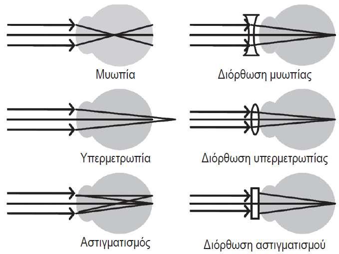 Ο ΑΝΘΡΩΠΙΝΟΣ ΟΦΘΑΛΜΟΣ Μυωπία: Ο βολβός του οφθαλμού είναι, σε σχέση με την ακτίνα καμπυλότητας του κερατοειδούς, περισσότερο επιμηκυμένος κατά μήκος του οπτικού άξονα.
