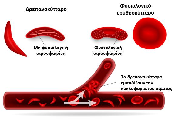 πολυμερών στο εσωτερικό των ερυθροκυττάρων. Τα πολυμερή αυτά δίνουν στα ερυθροκύτταρα το χαρακτηριστικό δρεπανοειδές σχήμα τους.