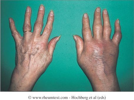 Gout of distal