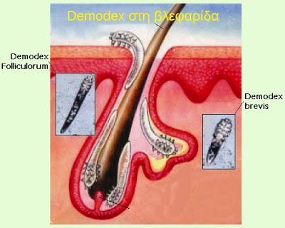 ΕΙΔΗ DEMODEX Demodex στον άνθρωπο: - Folliculorum (1842-Carl Gustav T. Simon¹) βρίσκεται στους θυλάκους των τριχών (τριχωτό κεφαλής/προσώπου, βλεφαρίδων, φρυδιών κ.α.) - Brevis (1963-AkBulatova²) κατοικεί στους σμηγματογόνους αδένες (μεϊβομιανούς) 1 Schaller M.