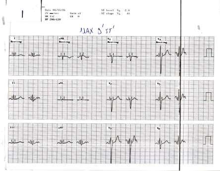 Έναρξη με 66ςφ/ λεπτό,απ 105/60mmHg,