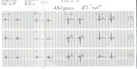 Έναρξη με 103 ςφ/ λεπτό, ΑΠ 110/80 mmhg, Κ