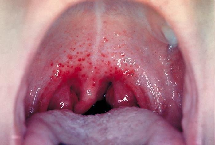 Στρεπτοκοκκική φαρυγγίτιδα (Streptococcus pyogenes) Κλινική Εξέταση Πυρετός 38,4 ο C Ερυθρότητα στο φάρυγγα, αμυγδαλές, μαλακή