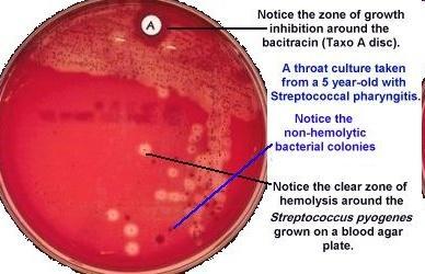 Στρεπτοκοκκική φαρυγγίτιδα (Streptococcus