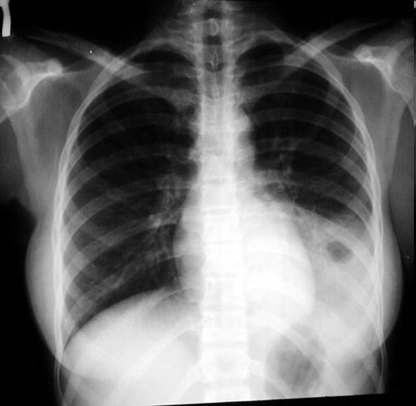 Πνευμονία από πνευμονιόκοκκο (Streptococcus pneumoniae) Εργαστηριακός έλεγχος Α/α θώρακα: πύκνωση κάτω λοβού αριστερού πνεύμονα