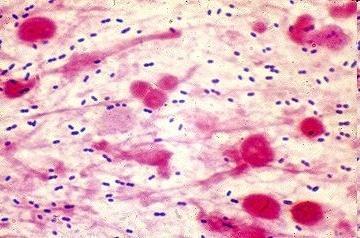 Πνευμονία από πνευμονιόκοκκο (Streptococcus pneumoniae) Εργαστηριακός έλεγχος