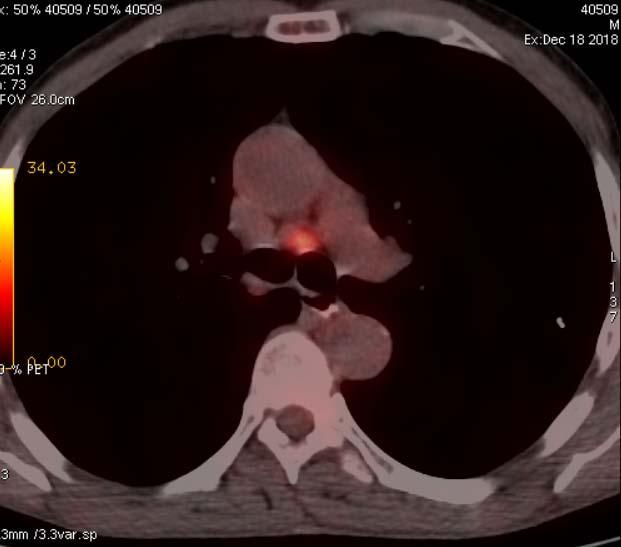 PET-CT ΧΚΕ 4,5cm: 10 SUV