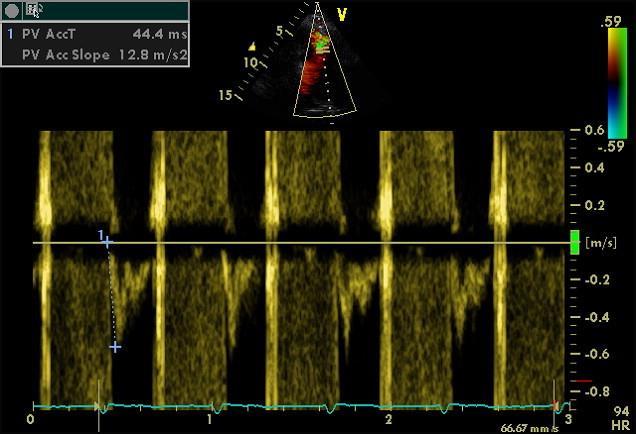 60/60 (AccT<60ms και RVSP<60mmHg) έχει ευαισθησία 25%, ειδικότητα 94%, θετική