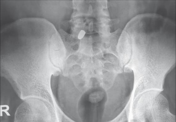 This radiograph of the pelvis demonstrates a