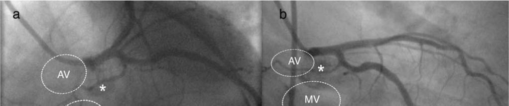 Βranch of the circumflex artery potentially suitable for transcoronary ablation