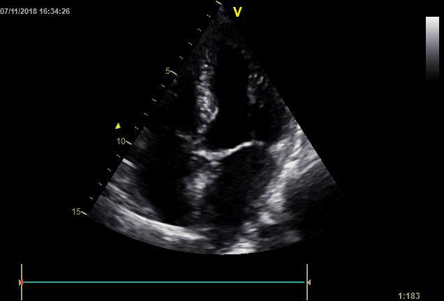 dysfunction of LV HF with preserved