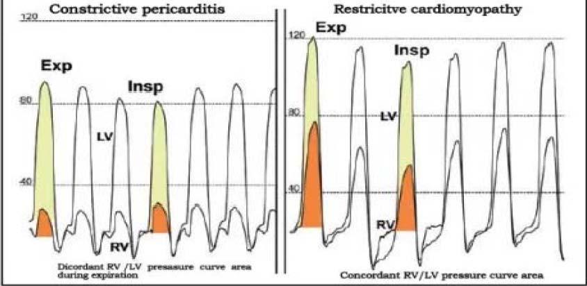 Systolic area index / /
