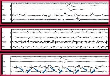 Catheter ablation of persistent