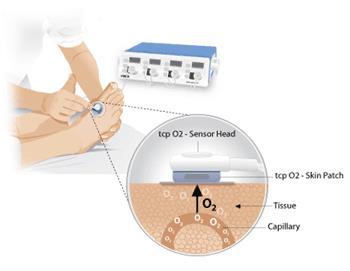 Διαδερμική τάση οξυγόνου (transcutaneous oxygen tension, TcPO 2 ) Αντανακλά την ποσότητα του Ο2 που διαχέεται στους ιστούς από τα τριχοειδή αγγεία του δέρματος άμεσος δείκτης