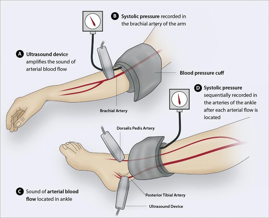 Κνημοβραχιόνιος δείκτης Measurement and interpretation of the ankle-brachial index.