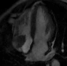 MRI καρδιάς παρουσία μορφώματος 24x19 mm στο οπίσθιο πλάγιο τοίχωμα του δεξιού κόλπου