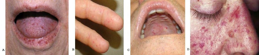 Εικόνα 1: Τηλαγγειεκτασίες δέρματος σε ασθενείς με σύνδρομο ΗΗΤ. A) Τηλαγγειεκτασίες στόματος και χειλιών. B) Τελαγγειεκτασίες δακτύλων του χεριού. C) Τηλαγγειεκτασίες της υπερώας.