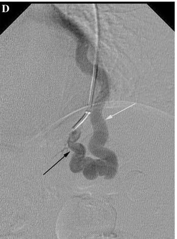 Εικόνα 2: Αγγειογραφεία του αριστερού κάτω λοβού ασθενούς με ΗΗΤ. Το μαύρο βέλος δείχνει την αρτηρία που τρέφει το σχηματιζόμενο PAVM, ενώ το άσπρο υποδεικνύει τη φλεβα (Από M.F. Carette et al.