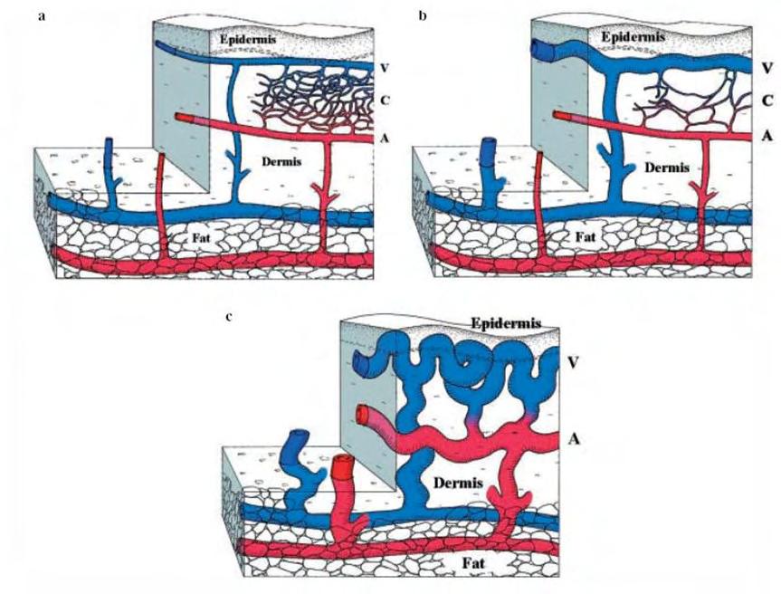 Εικόνα 6: Ανάπτυξη της τηλαγγειεκτασίας στην περιοχή του δέρματος και του βλεννογόνου. a) Φυσιολογικά αρτηρίδια (Α) στο χορίο συνδέονται με φλεβίδια (V) μέσω πολλαπλών τριχοειδών (C).