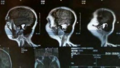 28 η ημέρα νοσηλείας MRI εγκεφάλου : Συλλογή υγρού συμβατό με ΕΝΥ στην ΜΤΧ περιοχή (λιθοειδές οστούν, μαστοειδείς κυψέλες) και σύστοιχα