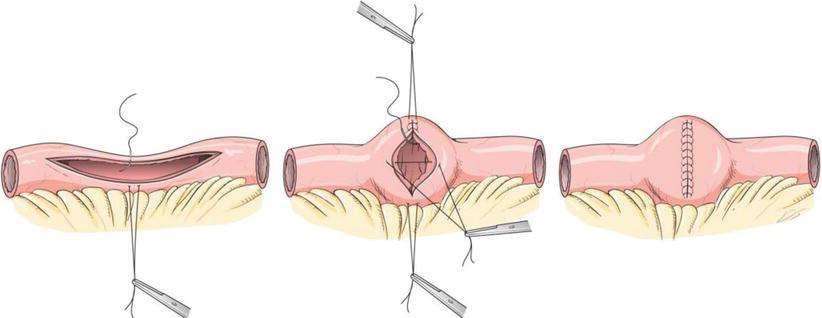 Ν.Crohn: