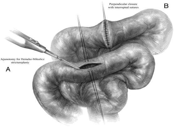 Ν.Crohn: